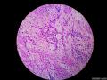 微信病例29 | 年轻人卵巢复杂的性索间质肿瘤图13