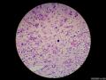 微信病例29 | 年轻人卵巢复杂的性索间质肿瘤图14