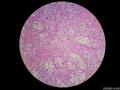 微信病例29 | 年轻人卵巢复杂的性索间质肿瘤图17
