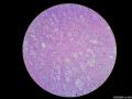 微信病例29 | 年轻人卵巢复杂的性索间质肿瘤图11