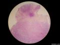 微信病例29 | 年轻人卵巢复杂的性索间质肿瘤图2