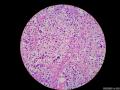 微信病例29 | 年轻人卵巢复杂的性索间质肿瘤图7