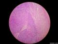 微信病例29 | 年轻人卵巢复杂的性索间质肿瘤图19