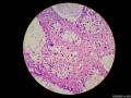 微信病例29 | 年轻人卵巢复杂的性索间质肿瘤图20