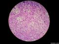 微信病例29 | 年轻人卵巢复杂的性索间质肿瘤图10