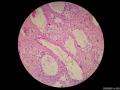 微信病例29 | 年轻人卵巢复杂的性索间质肿瘤图15