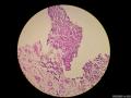 微信病例29 | 年轻人卵巢复杂的性索间质肿瘤图12