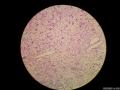 微信病例29 | 年轻人卵巢复杂的性索间质肿瘤图16