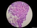 微信病例29 | 年轻人卵巢复杂的性索间质肿瘤图18