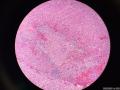 微信病例34 | 肾上腺球孢子菌病图5