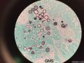 微信病例34 | 肾上腺球孢子菌病图9