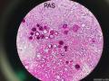 微信病例34 | 肾上腺球孢子菌病图8