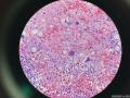 微信病例34 | 肾上腺球孢子菌病图7