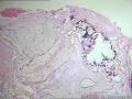 卵巢表面赘生物---浆液性表面乳头状瘤图4