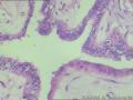 卵巢表面赘生物---浆液性表面乳头状瘤图13