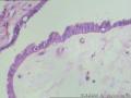 卵巢表面赘生物---浆液性表面乳头状瘤图12