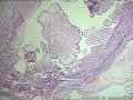 卵巢表面赘生物---浆液性表面乳头状瘤图2