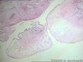 卵巢表面赘生物---浆液性表面乳头状瘤图3