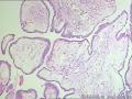 卵巢表面赘生物---浆液性表面乳头状瘤图6