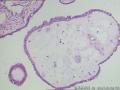 卵巢表面赘生物---浆液性表面乳头状瘤图11