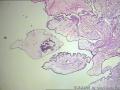 卵巢表面赘生物---浆液性表面乳头状瘤图1