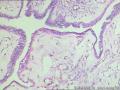 卵巢表面赘生物---浆液性表面乳头状瘤图7