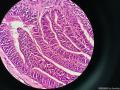 乳腺乳头状瘤，细胞呈高细胞样。图7