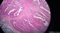 乳腺乳头状瘤，细胞呈高细胞样。图3