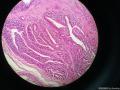 乳腺乳头状瘤，细胞呈高细胞样。图6