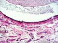 输卵管囊肿图17