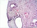 输卵管囊肿图15