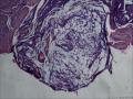 子宫体平滑肌瘤图28