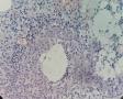 浆细胞乳腺炎图8