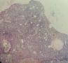 浆细胞乳腺炎图2
