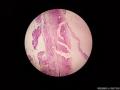 宫颈息肉（感觉腺体的细胞怎么那么大）图2