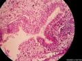宫颈息肉（感觉腺体的细胞怎么那么大）图1