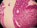 宫颈息肉（感觉腺体的细胞怎么那么大）图7