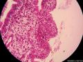 宫颈息肉（感觉腺体的细胞怎么那么大）图10