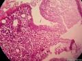 宫颈息肉（感觉腺体的细胞怎么那么大）图6
