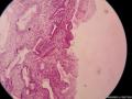 宫颈息肉（感觉腺体的细胞怎么那么大）图9