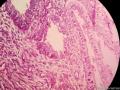 宫颈息肉（感觉腺体的细胞怎么那么大）图8