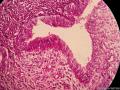 宫颈息肉（感觉腺体的细胞怎么那么大）图4