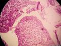 宫颈息肉（感觉腺体的细胞怎么那么大）图5