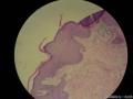 阴茎系膜赘生物图8