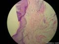阴茎系膜赘生物图10