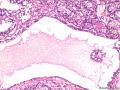 膀胱肿瘤图15