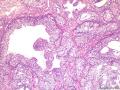 膀胱肿瘤图5