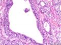 膀胱肿瘤图18
