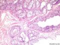 膀胱肿瘤图6