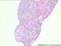 腹腔内的吸出组织--宫外孕未见绒毛，后补了几张内膜的图9